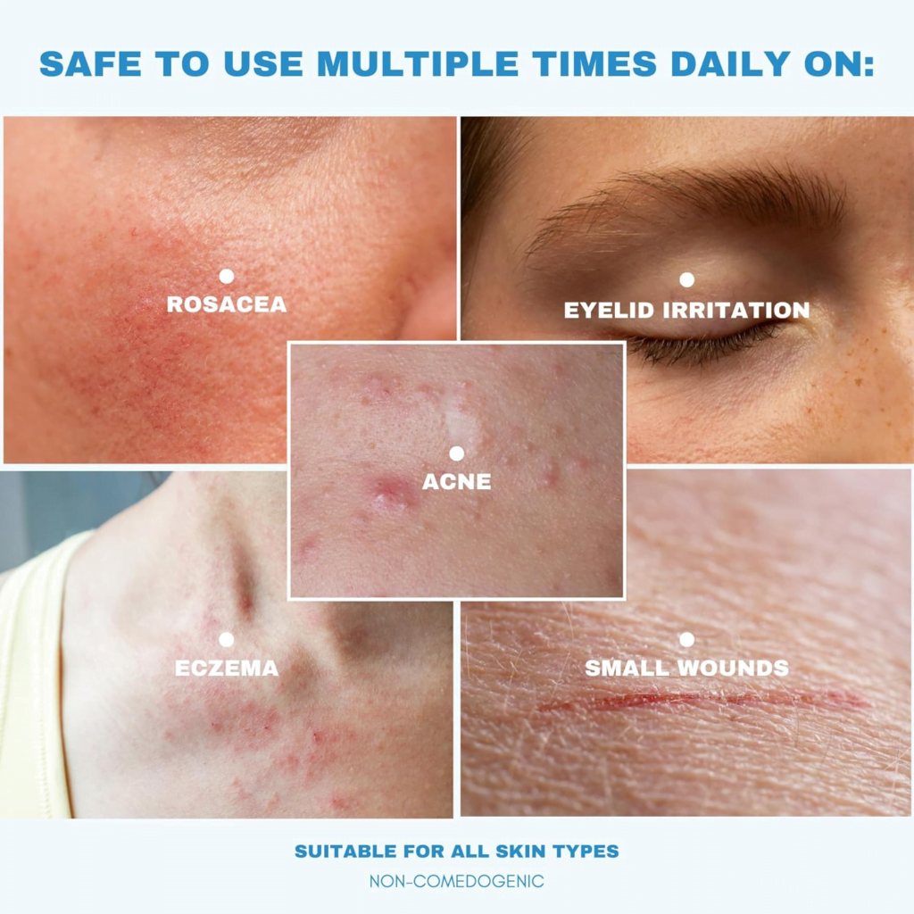 Hypochlorous Acid Spray safe for daily use on acne, redness, rosacea, eczema, and eyelid irritation